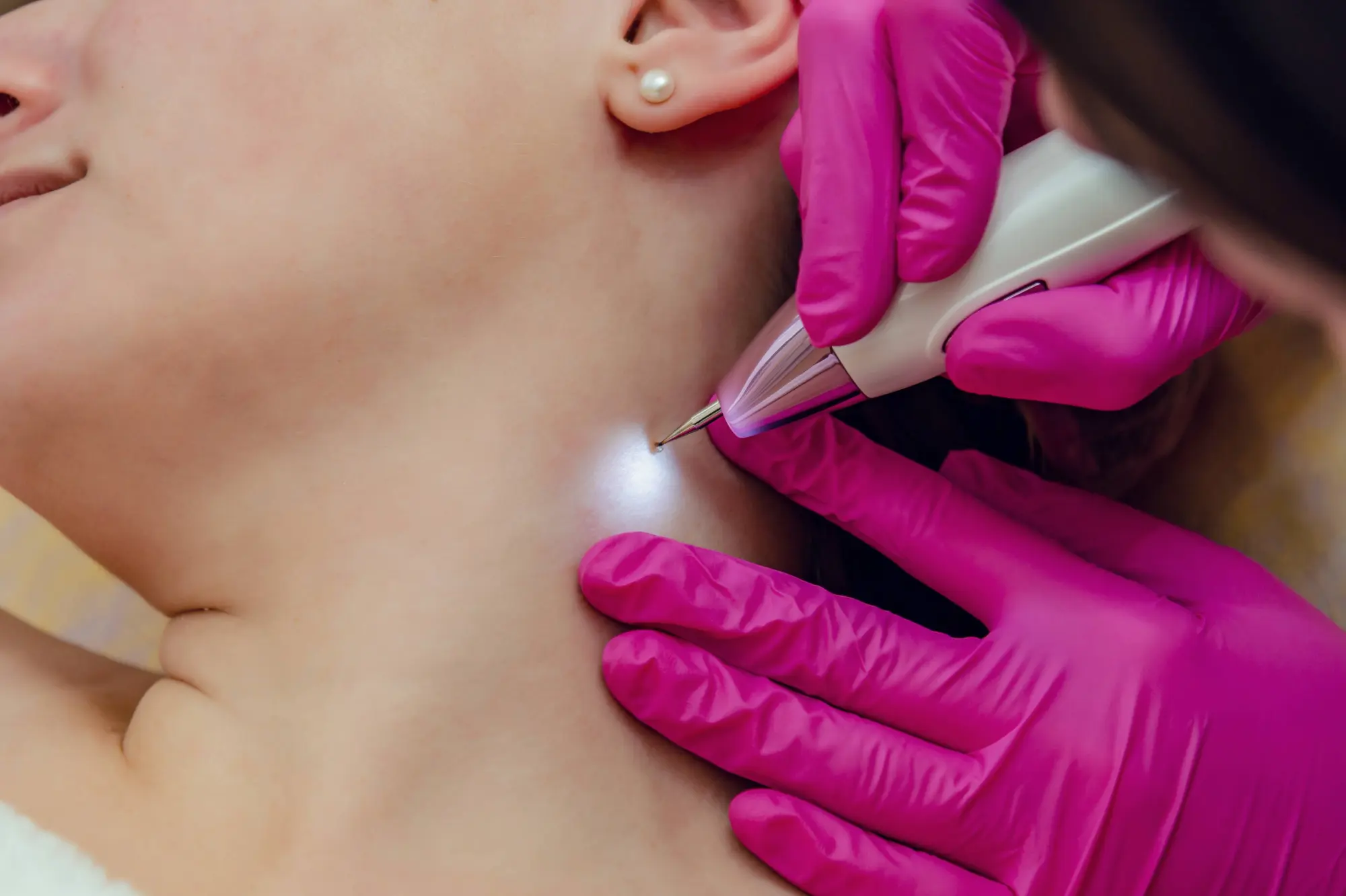 Biltmore Dermatology removing a Skin tag from a client